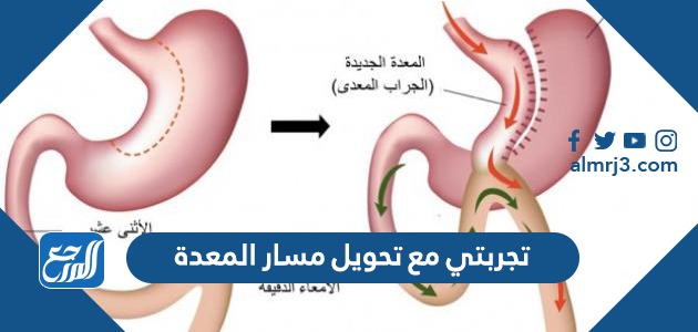 تجربتي مع تحويل مسار المعدة