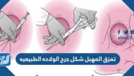 تمزق المهبل شكل جرح الولاده الطبيعيه