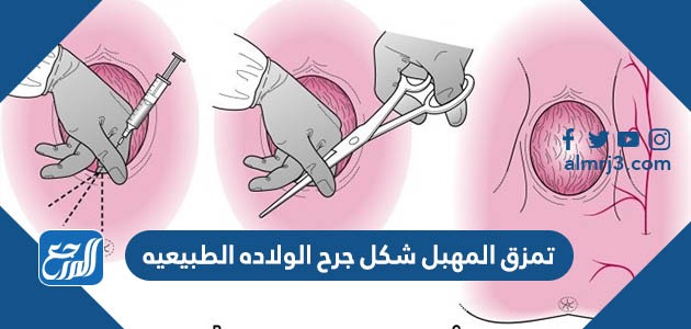 تمزق المهبل شكل جرح الولاده الطبيعيه