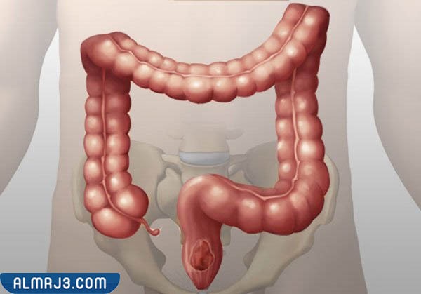 تنظيف القولون من البراز المتحجر بالوصفات الطبيعية 