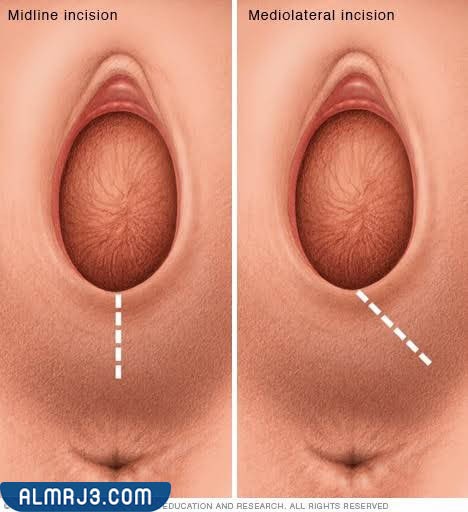 حالات تمزق المهبل بعد الولادة الطبيعية