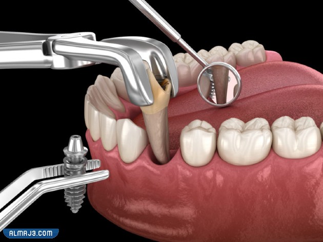 أسعار زراعة الأسنان الفورية في الرياض