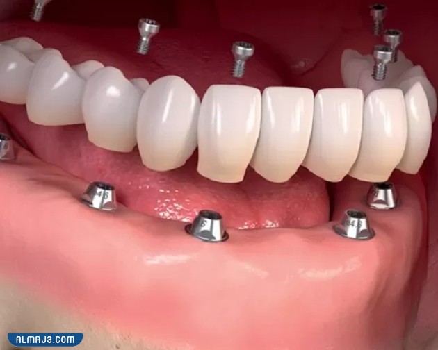 أسعار زراعة الأسنان الفورية في الرياض