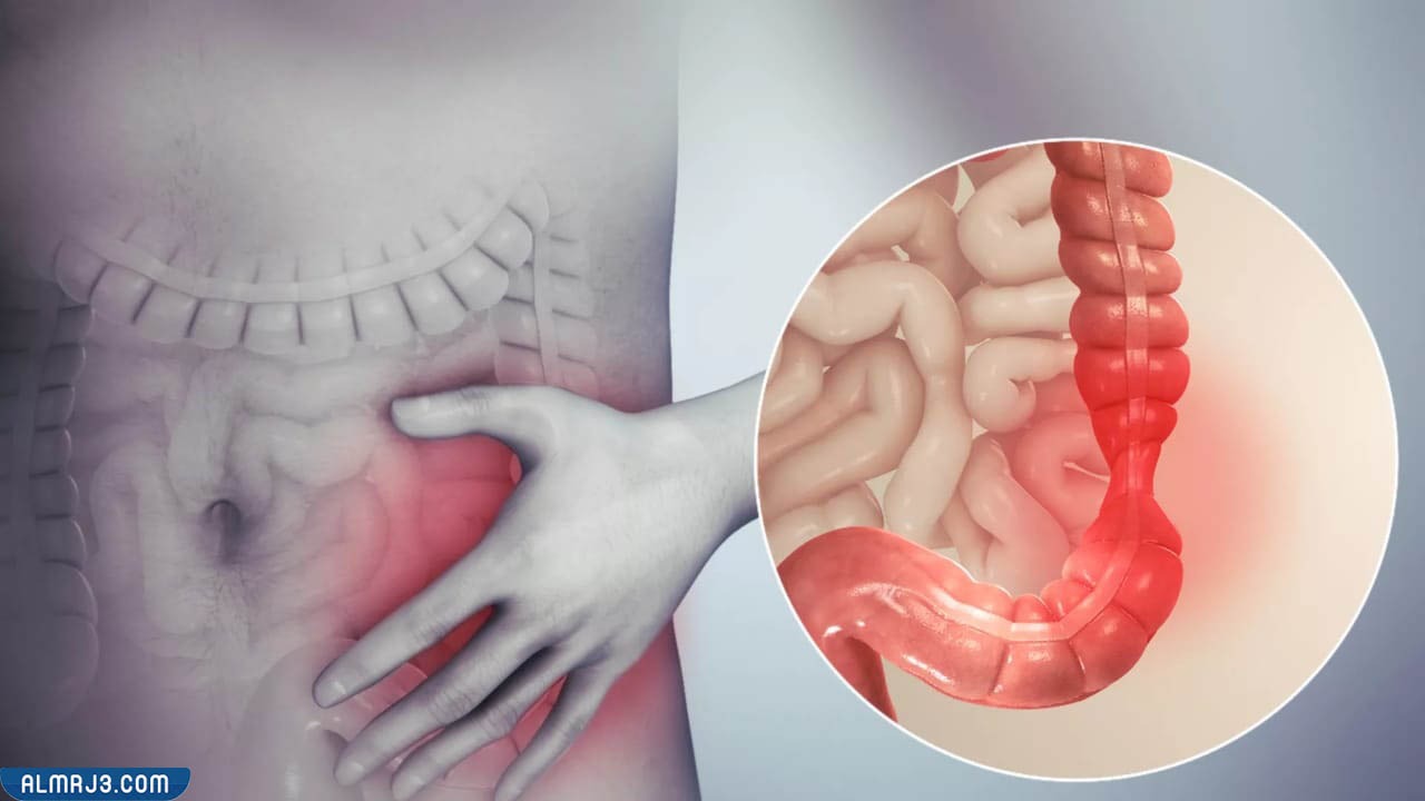 سبب تحجر البراز في القولون 