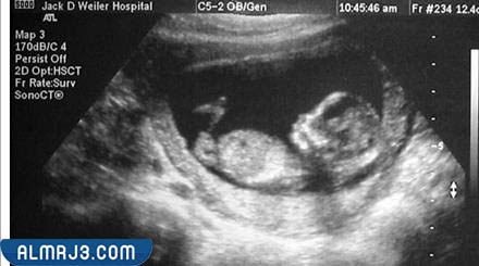 شكل الجنين البنت 