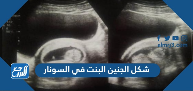 شكل الجنين البنت في السونار