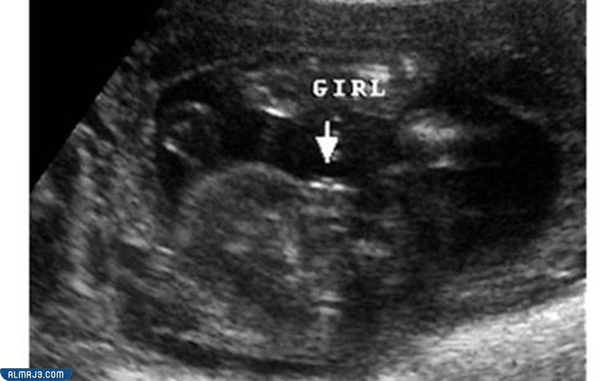 شكل الجنين البنت في الشهر الثاني بالسونار 