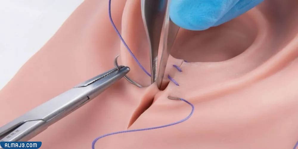 تمزق المهبل شكل جرح الولاده الطبيعيه