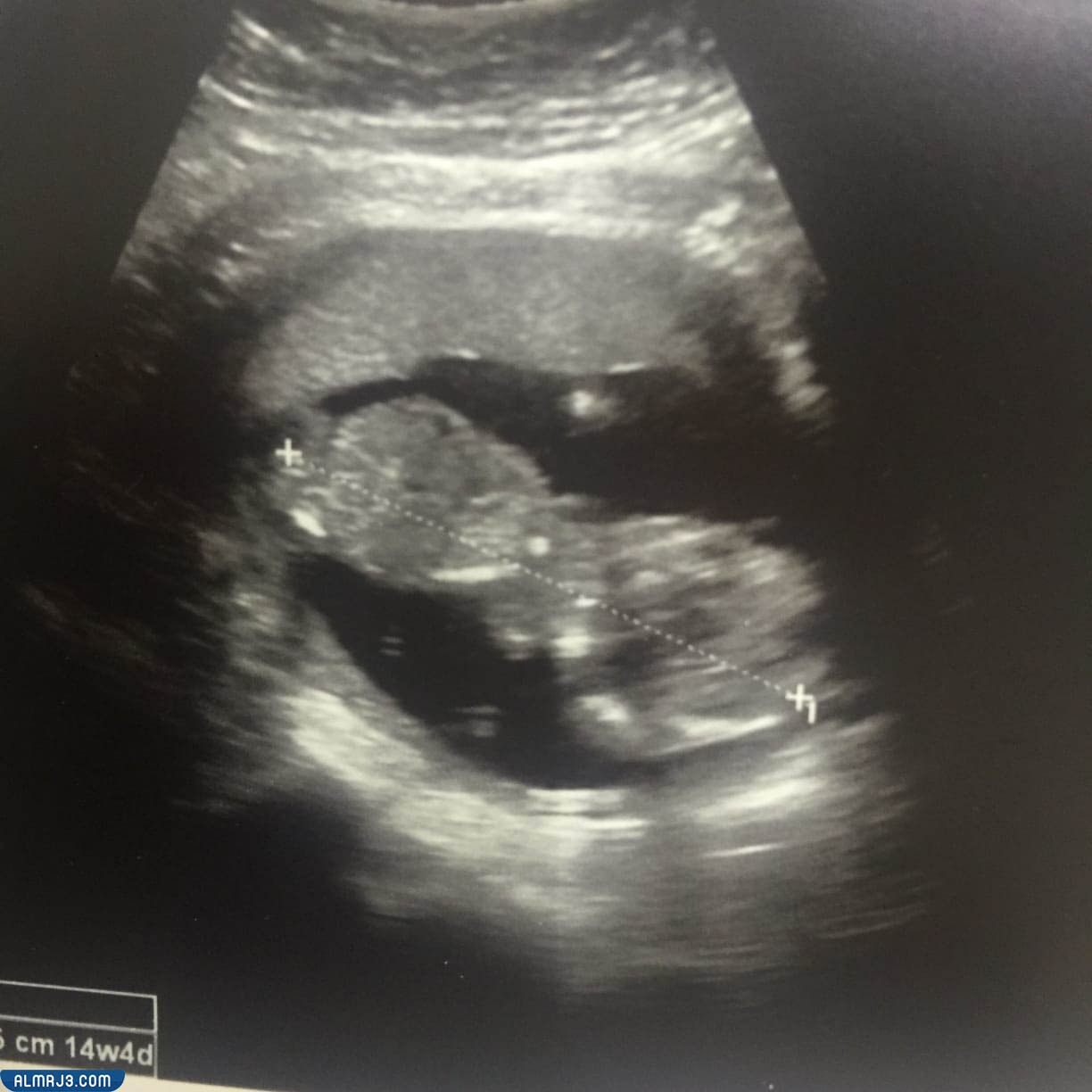 عوامل تؤثر على معرفة نوع الجنين البنت بالسونار 