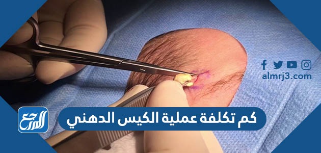 كم تكلفة عملية الكيس الدهني في السعودية