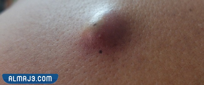 كم تكلفة عملية الكيس الدهني في السعودية؟