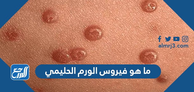 ما هو فيروس الورم الحليمي