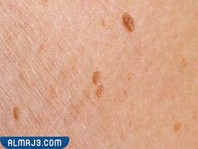 ما هو فيروس الورم الحليمي بالصور 