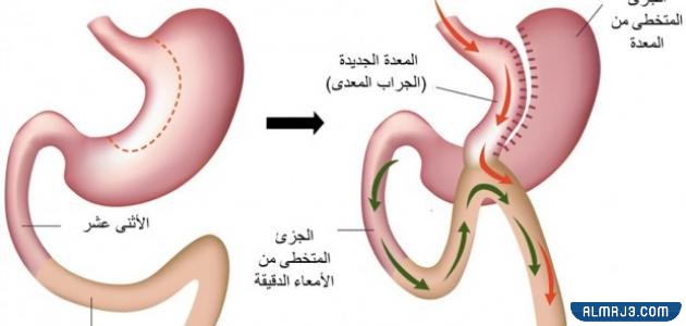 ما هي عملية تحويل المسار