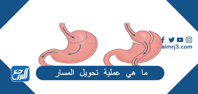 تجربتي مع تحويل مسار المعده