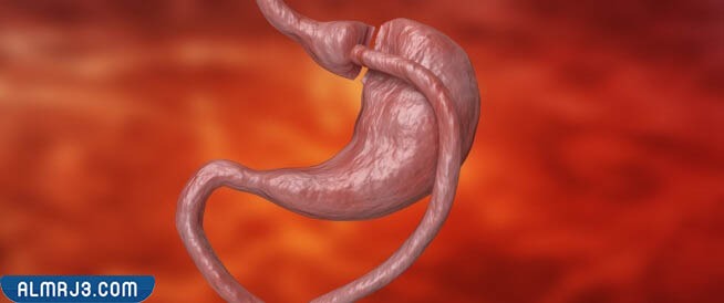 ما هي عملية تحويل مسار المعدة