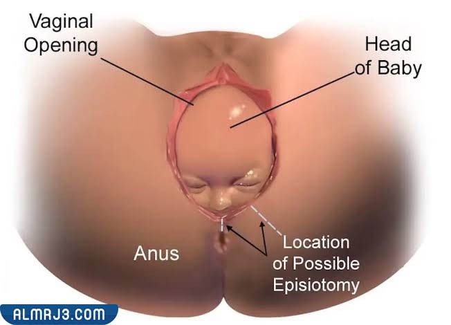 مدة التئام حرج الولادة الطبيعية