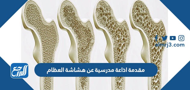 مقدمة اذاعة مدرسية عن هشاشة العظام