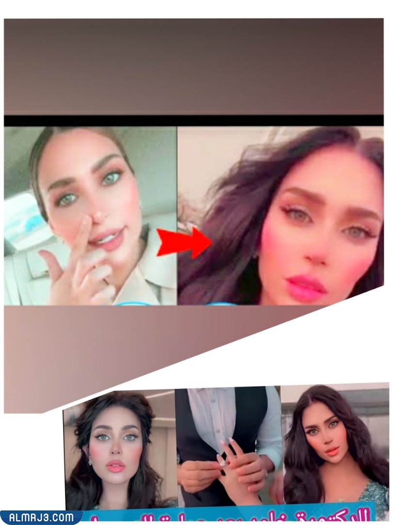 دكتورة خلود قبل وبعد التجميل