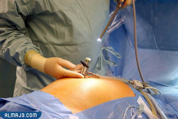 منظار الرحم قبل الحقن المجهري 