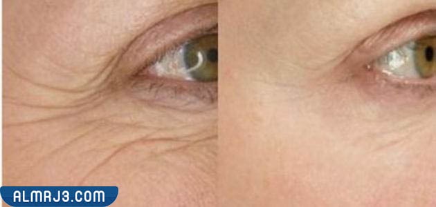 الفيلر تحت العين قبل وبعد