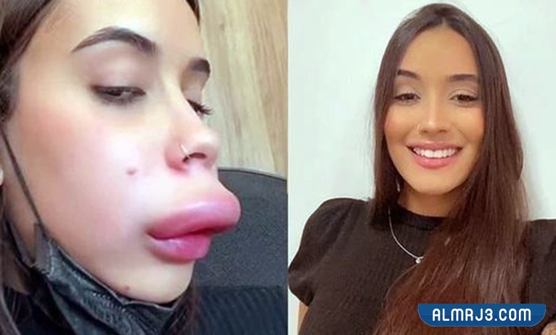 تجربتي الفاشله مع الفيلر