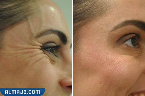 الفيلر تحت العين قبل وبعد