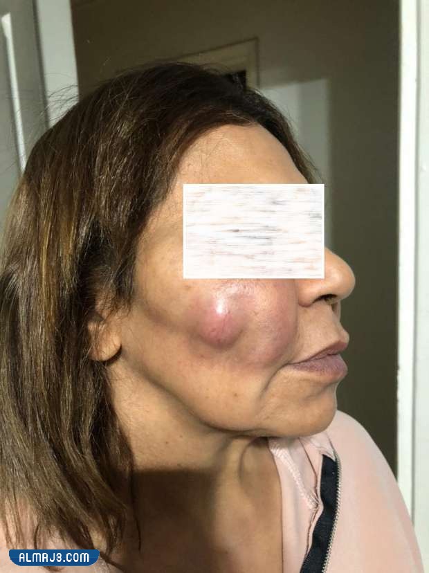 تجربتي الفاشله مع الفيلر