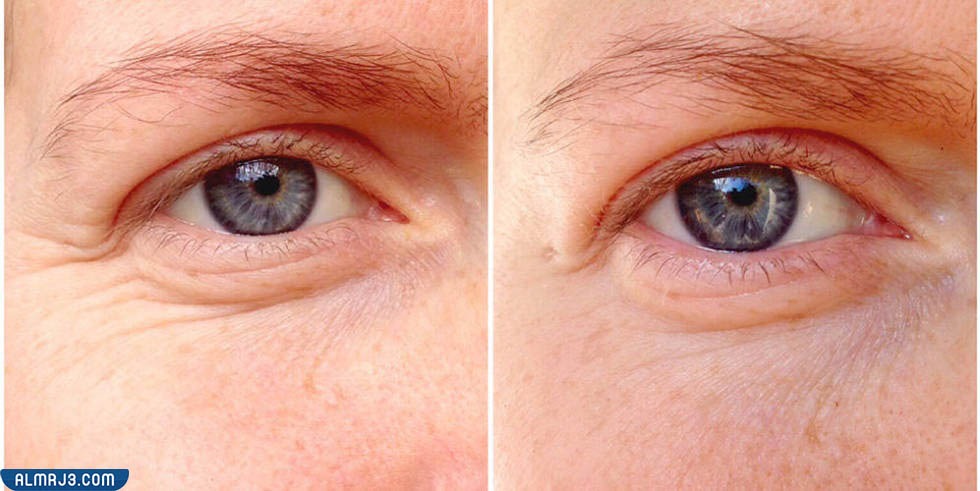 الفيلر تحت العين قبل وبعد