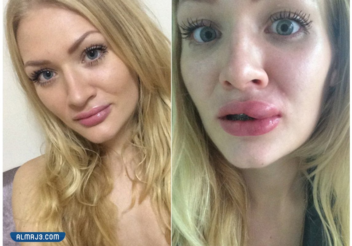 تجربتي الفاشله مع الفيلر