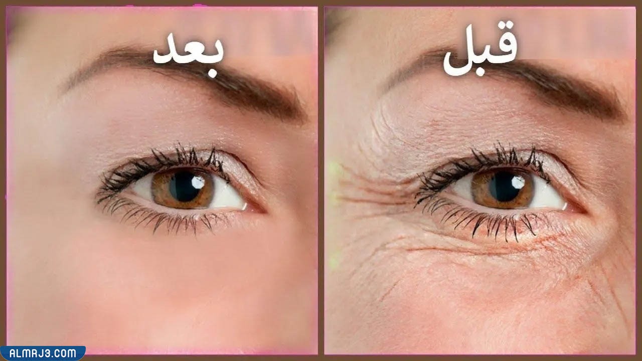 الفيلر تحت العين قبل وبعد