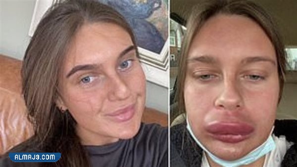 تجربتي الفاشله مع الفيلر