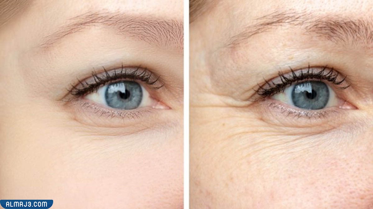 الفيلر تحت العين قبل وبعد