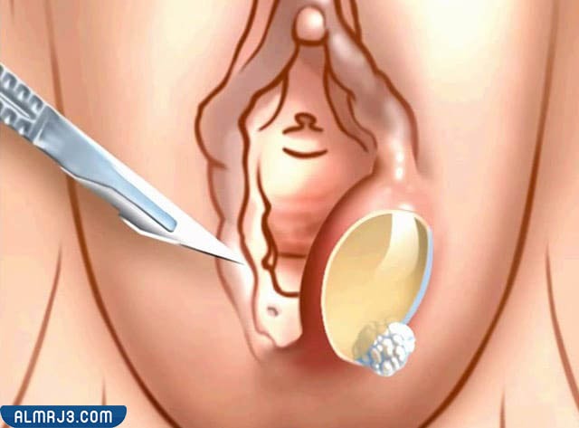 أسباب التهاب غدة بارثولين 