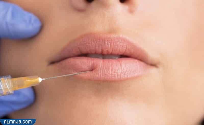 أسباب تحرك الفيلر من مكانه