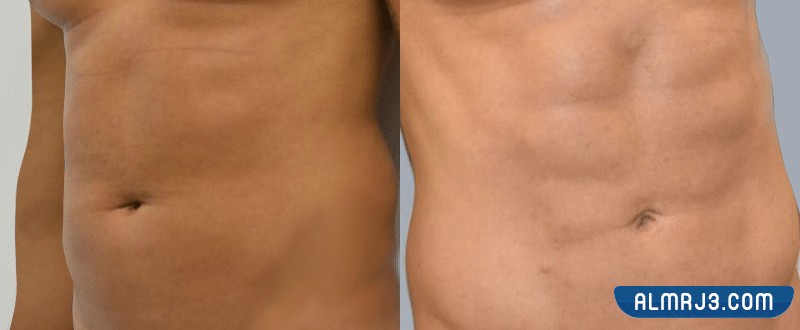 أنواع شفط الدهون بالفيزر