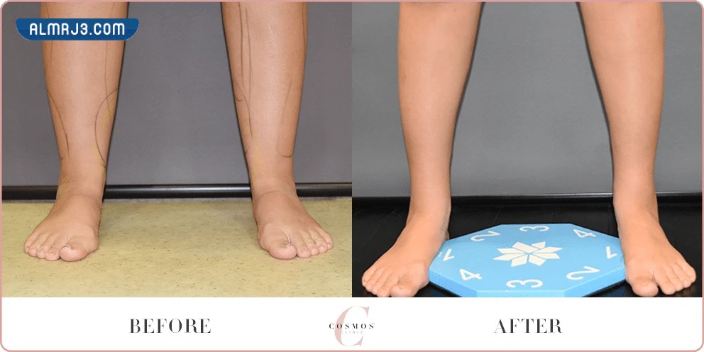 أنواع شفط الدهون بالفيزر