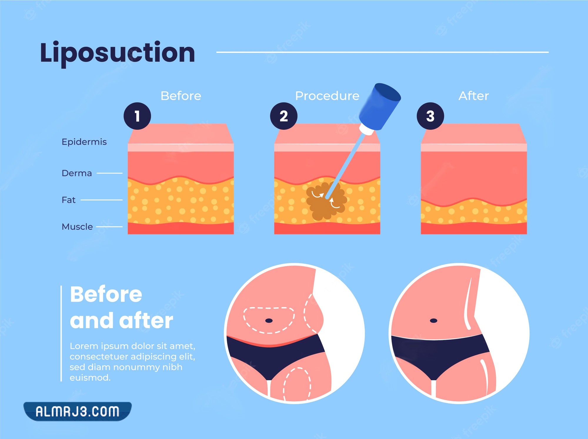 أنواع شفط الدهون بالفيزر