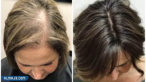 استخدامات فيلر الشعر