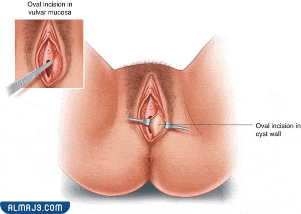 المضاعفات الناتجة عن غدة بارثولين 