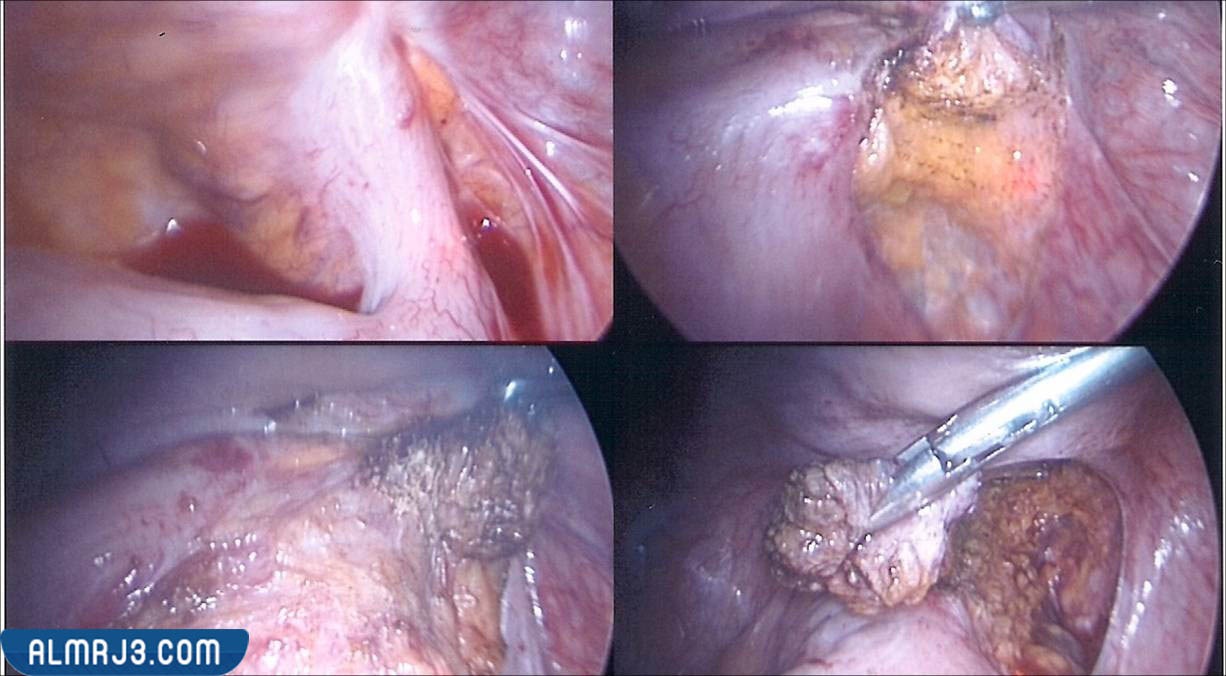بطانة الرحم المهاجرة السطحية