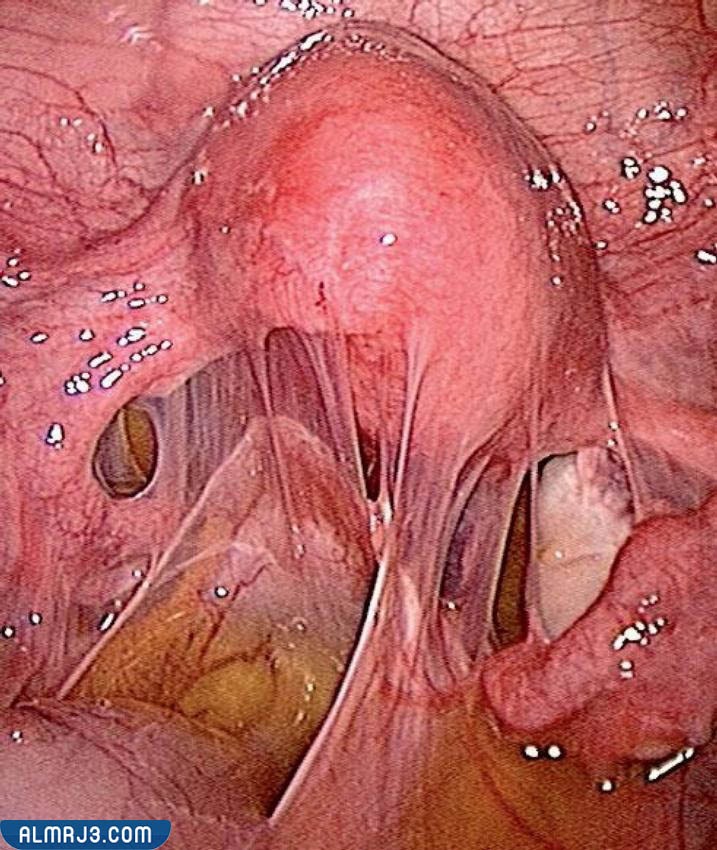 بطانة الرحم المهاجرة العميقة