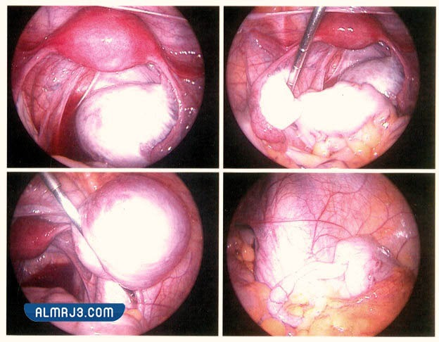 بطانة الرحم المهاجرة المبيضية الكيسية
