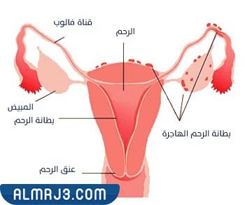 كيف عرفتي عندك بطانة الرحم المهاجرة