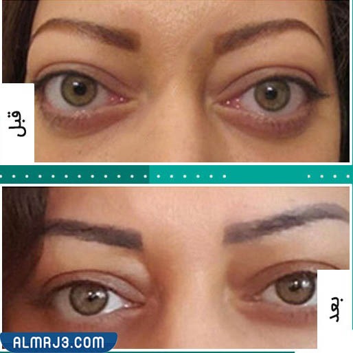 الفيلر تحت العين قبل وبعد