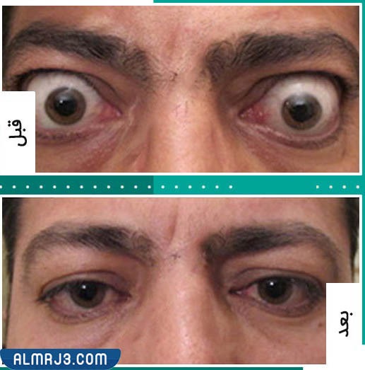 الفيلر تحت العين قبل وبعد