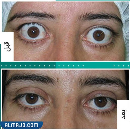الفيلر تحت العين قبل وبعد