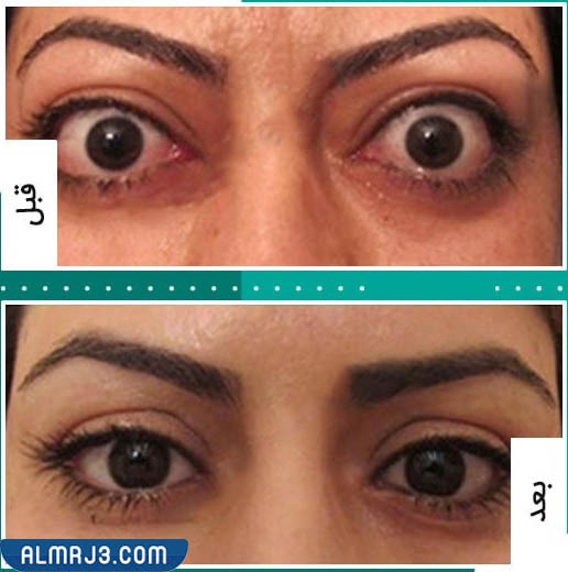 الفيلر تحت العين قبل وبعد