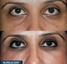 صور توضح قبل وبعد استخدام الفيلر لعلاج مشكلة العيون الغائرة