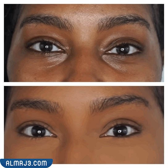 صور توضح قبل وبعد استخدام الفيلر لعلاج مشكلة العيون الغائرة